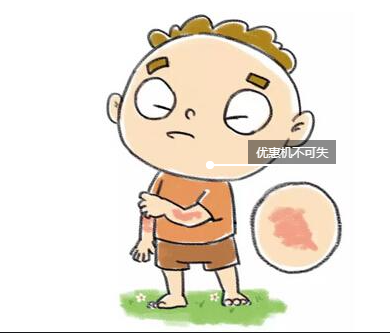 少年兒童患特應性皮炎 少年兒童患特應性皮炎